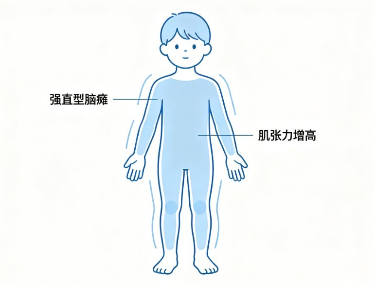 强直型脑瘫