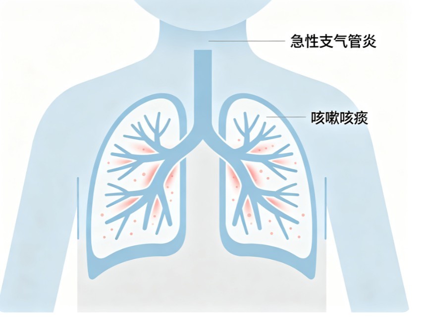 小儿急性支气管炎