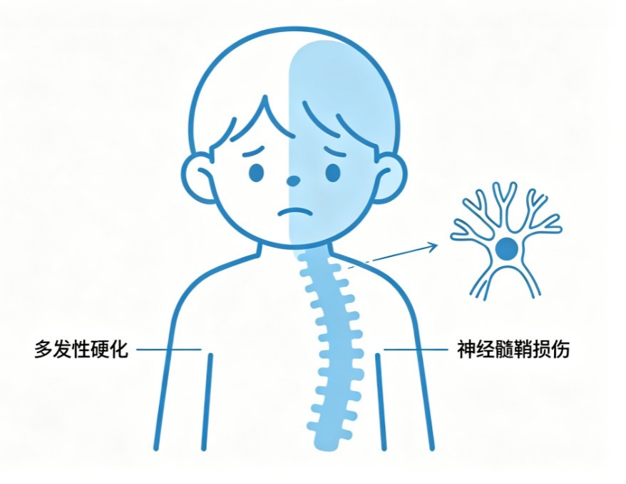 小儿多发性硬化