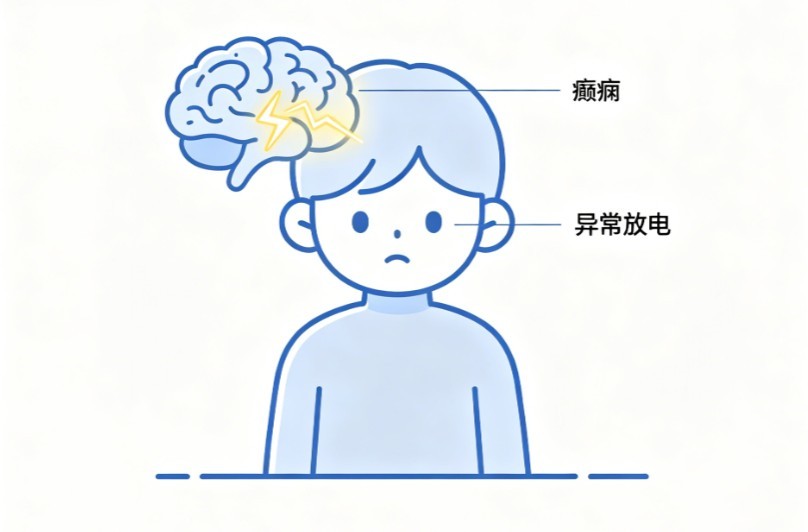小儿癫痫