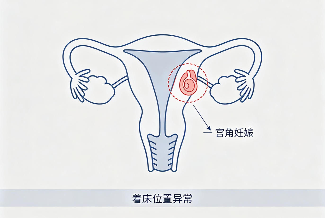 宫角妊娠