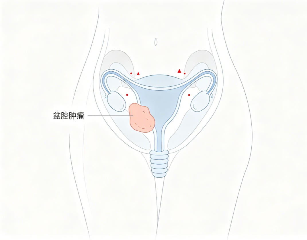 盆腔肿瘤