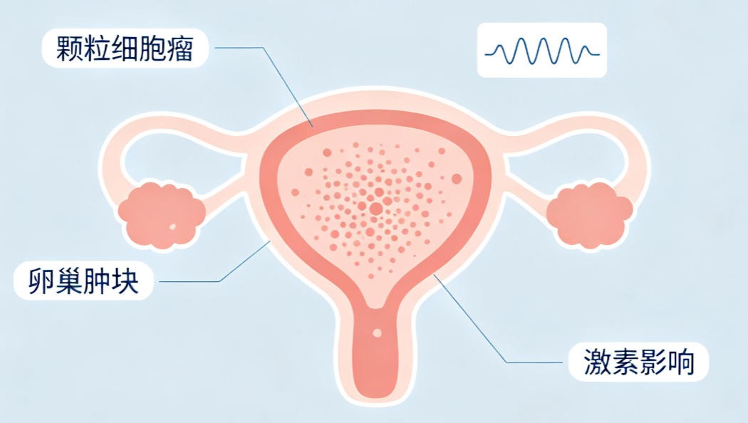 卵巢颗粒细胞瘤