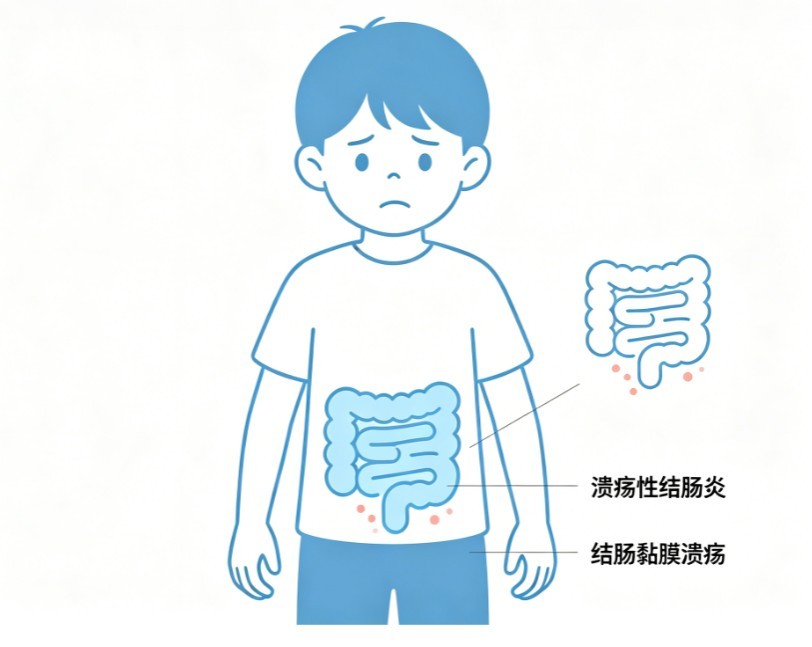 小儿溃疡性结肠炎