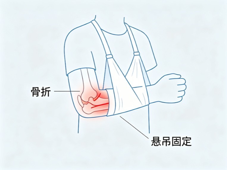 小儿骨折