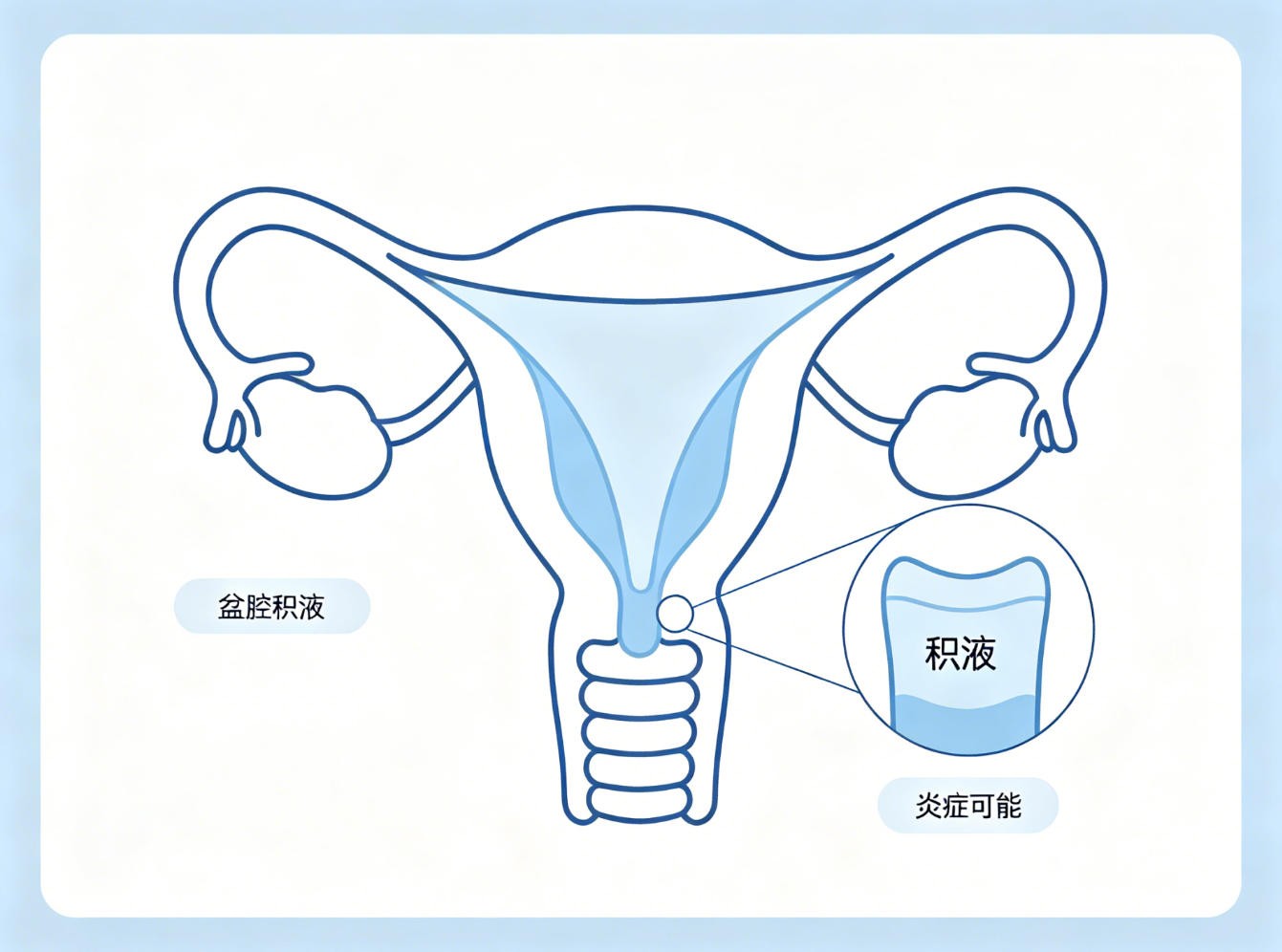 盆腔积液