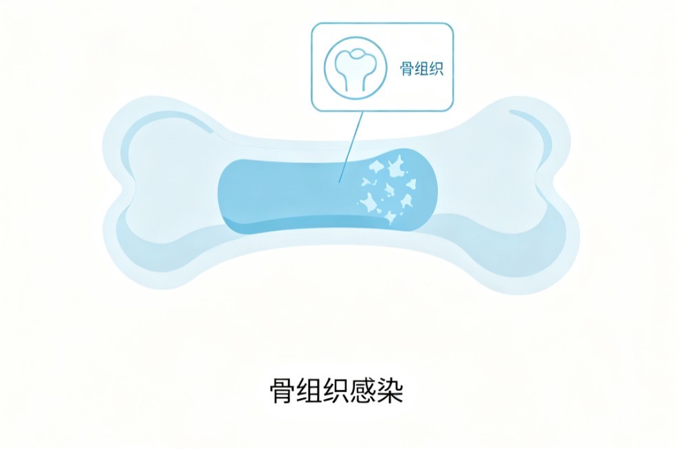 短骨骨干结核