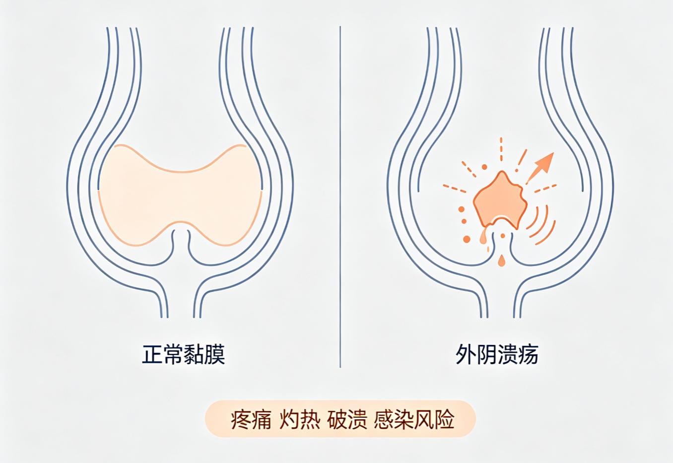 外阴溃疡