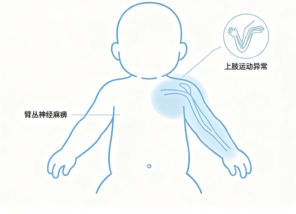 新生儿臂丛神经麻痹