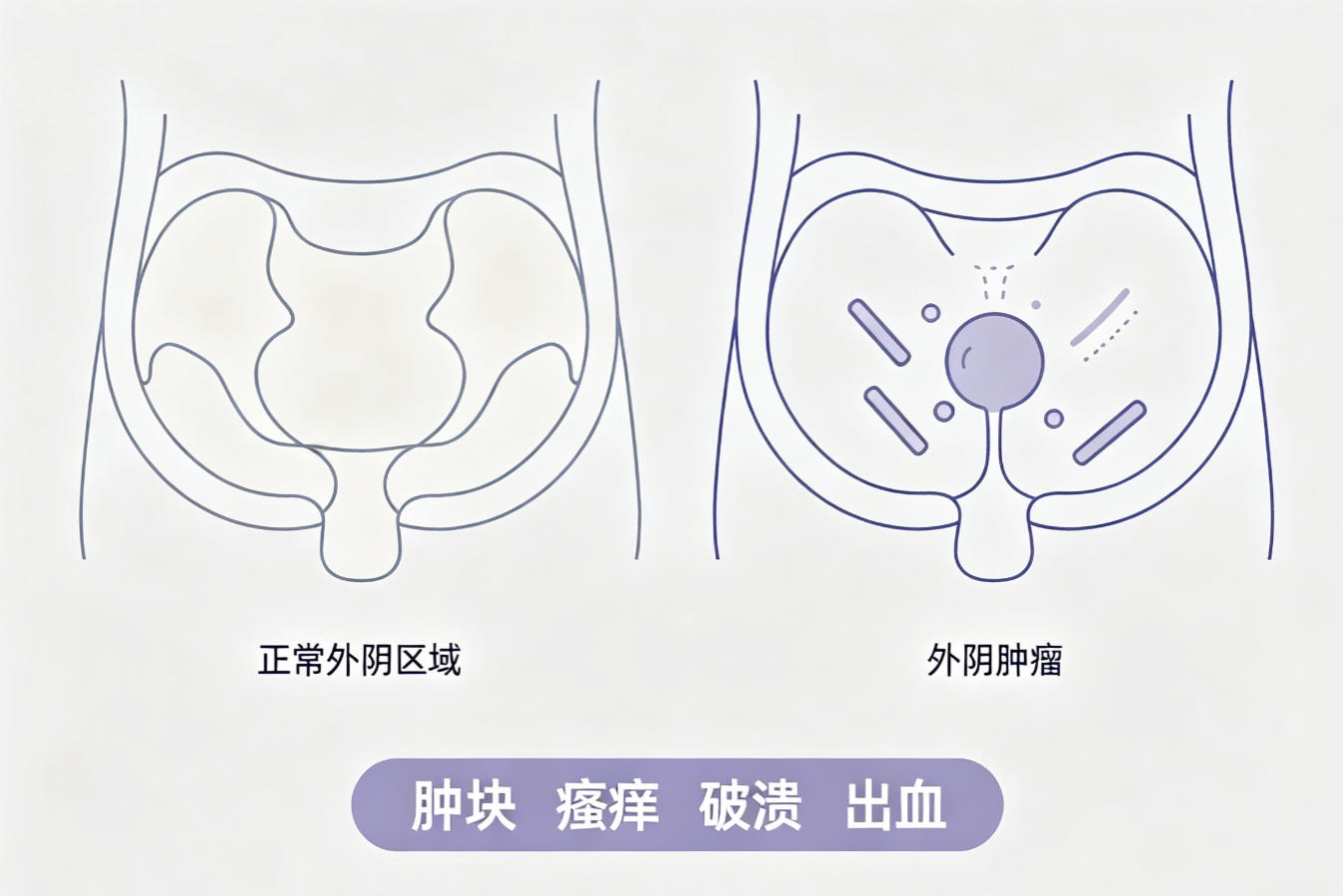 外阴肿瘤
