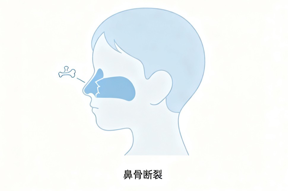 鼻骨骨折
