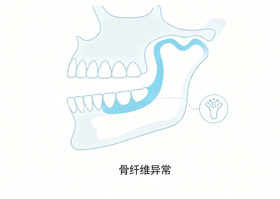 骨化性纤维瘤