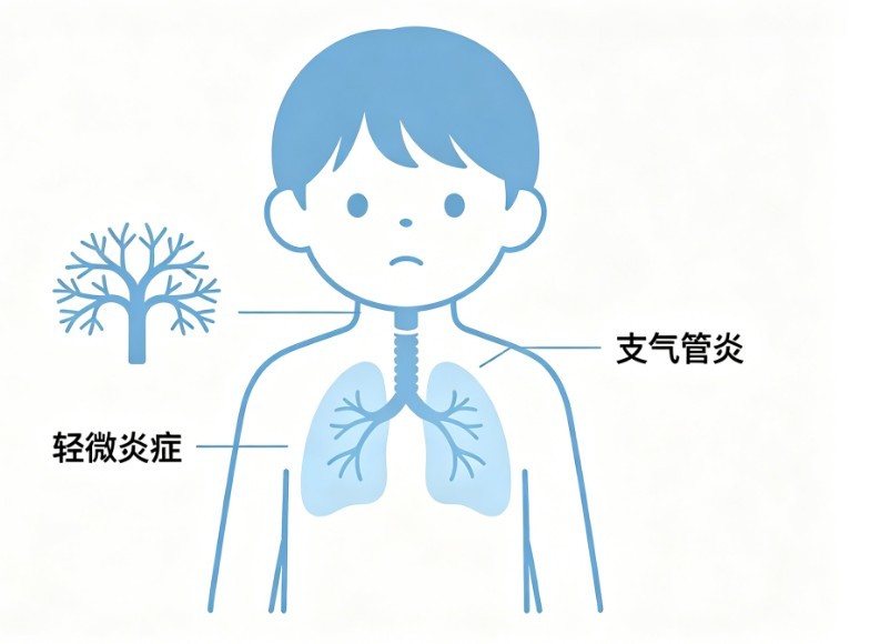 小儿支气管炎