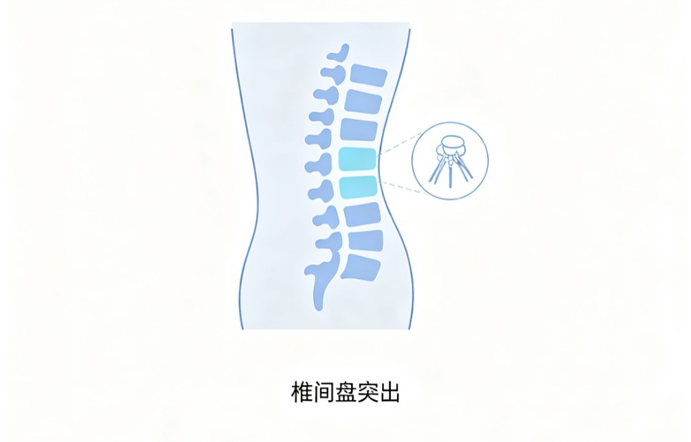 腰间盘突出