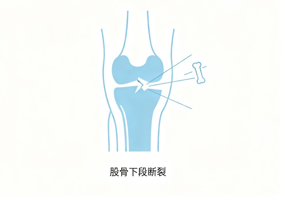 股骨转子下骨折