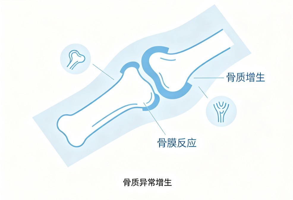 增生性骨关节病