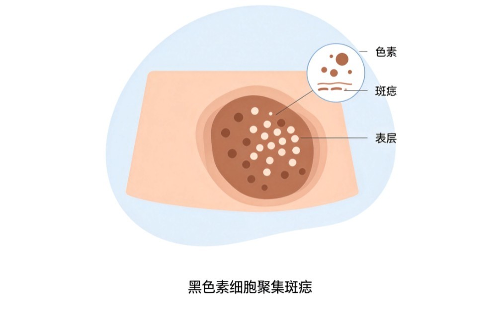 黑痣