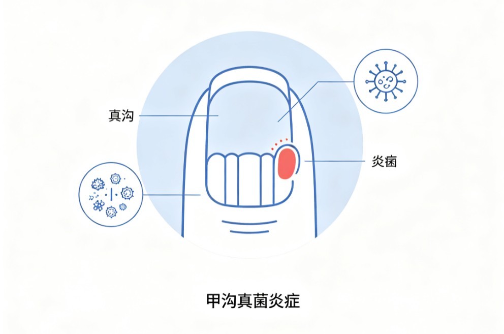 念珠菌性甲沟炎