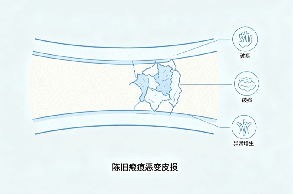 瘢痕癌