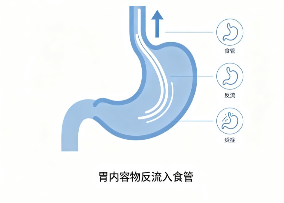 反流性食管炎