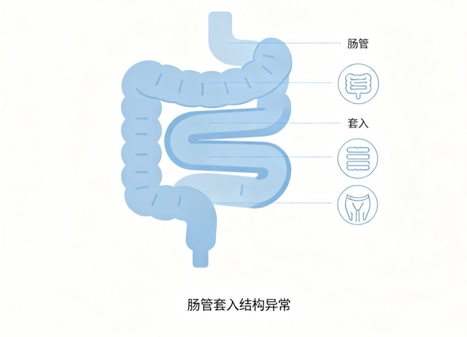 肠套叠
