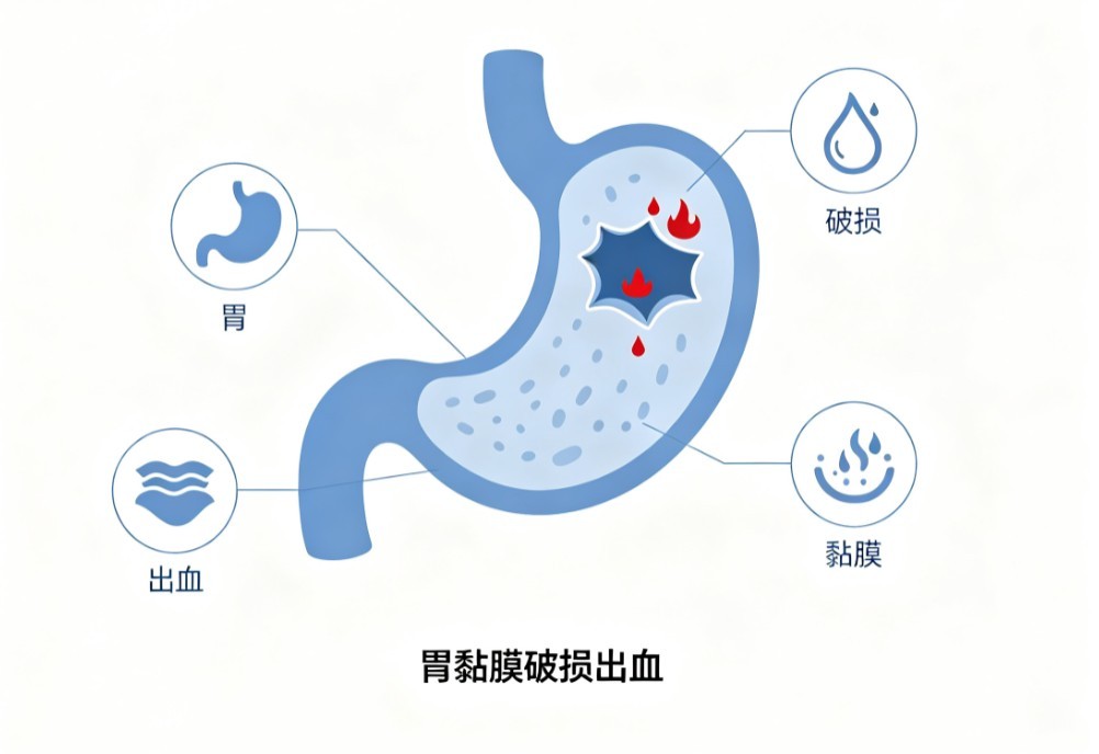 胃溃疡出血