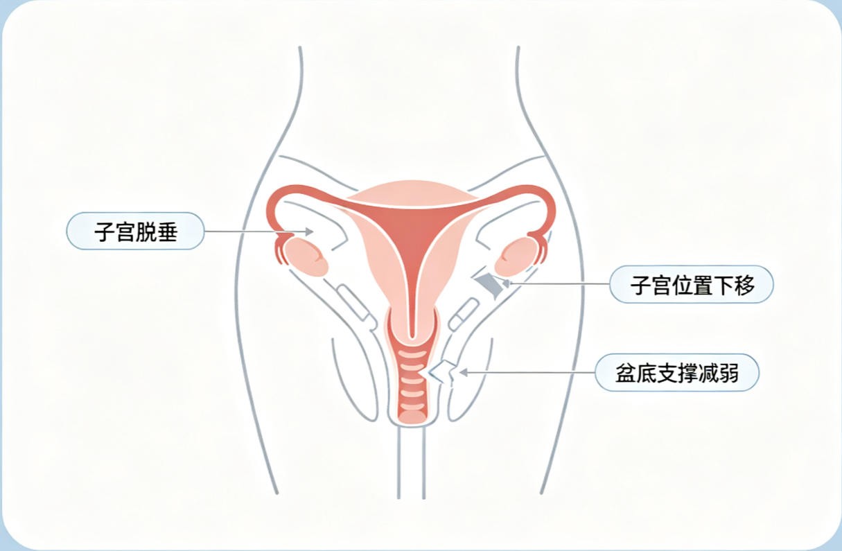 子宫脱垂