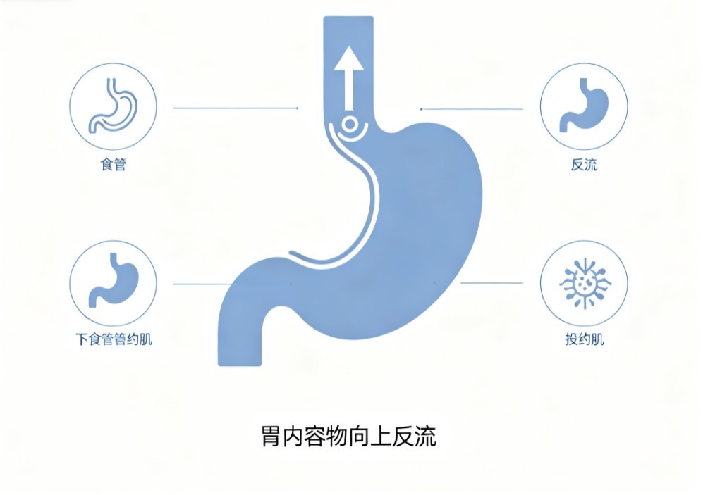 胃食管反流病