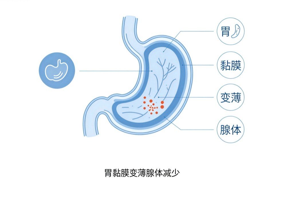 慢性萎缩性胃炎