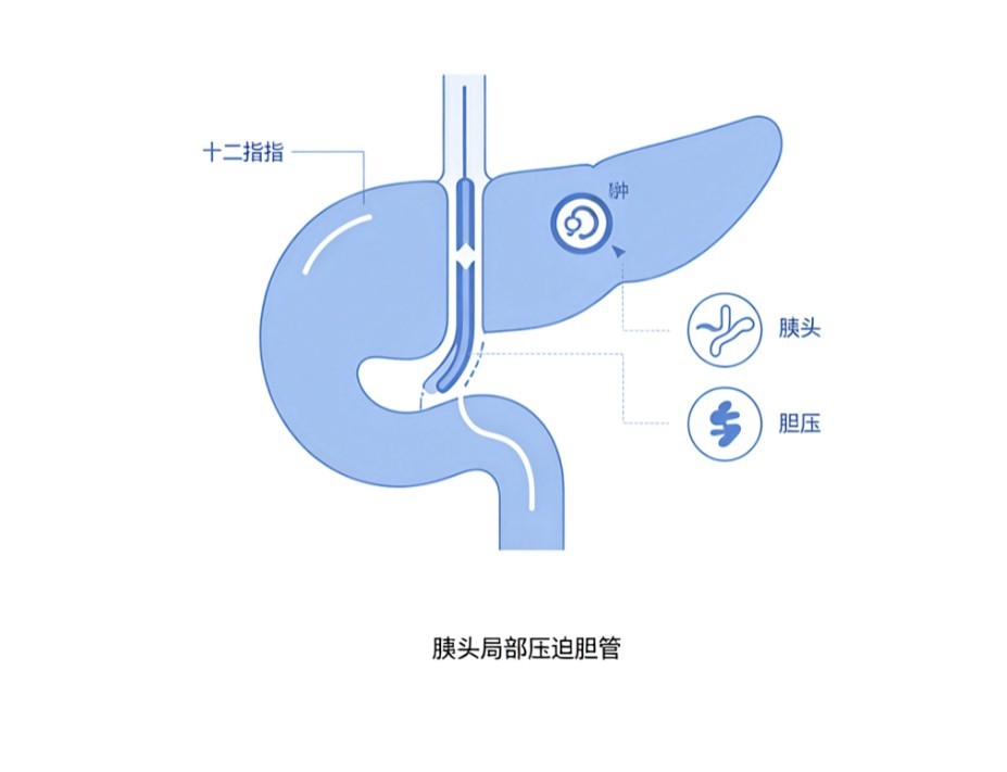 胰头癌