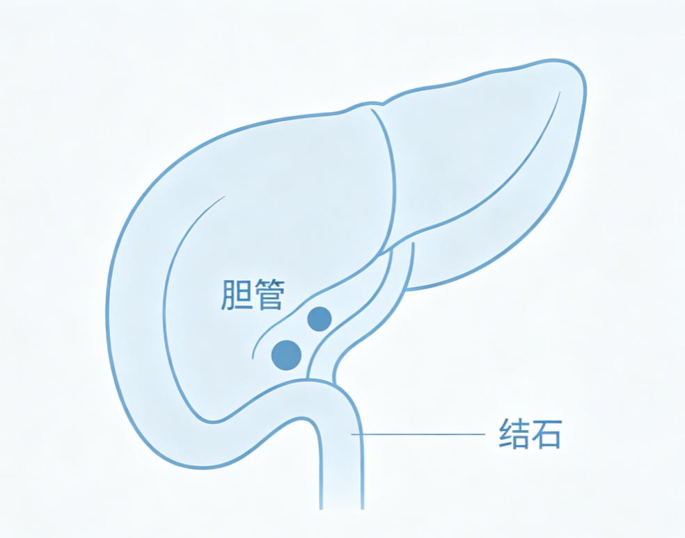 胆管结石