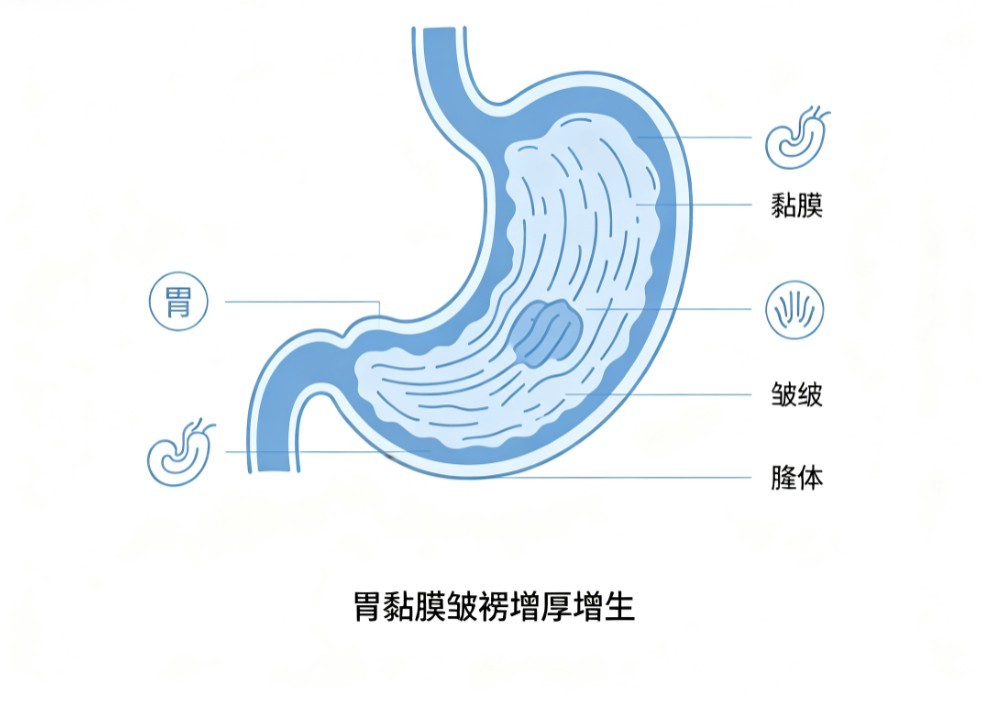 巨大肥厚性胃炎