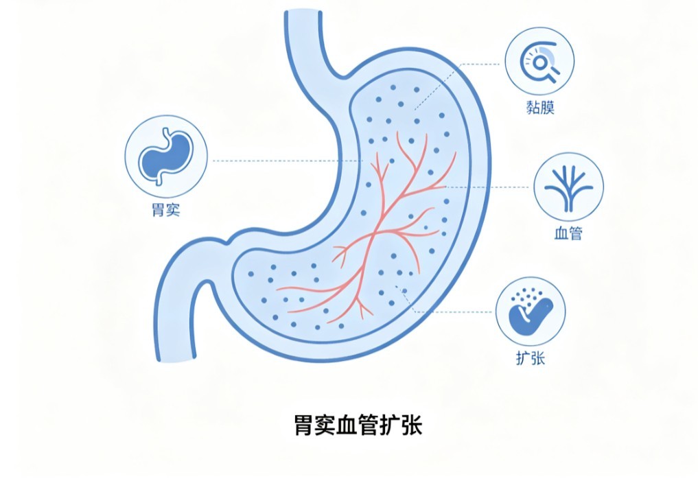 胃窦血管扩张症