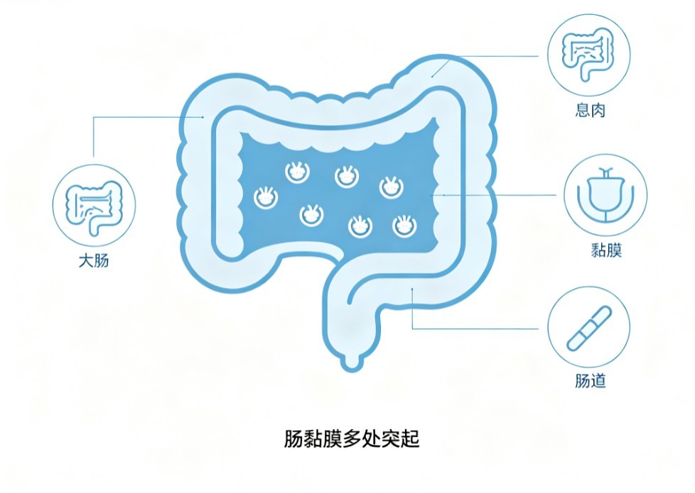 肠道息肉病