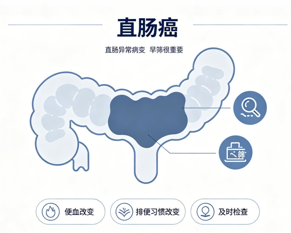 直肠癌