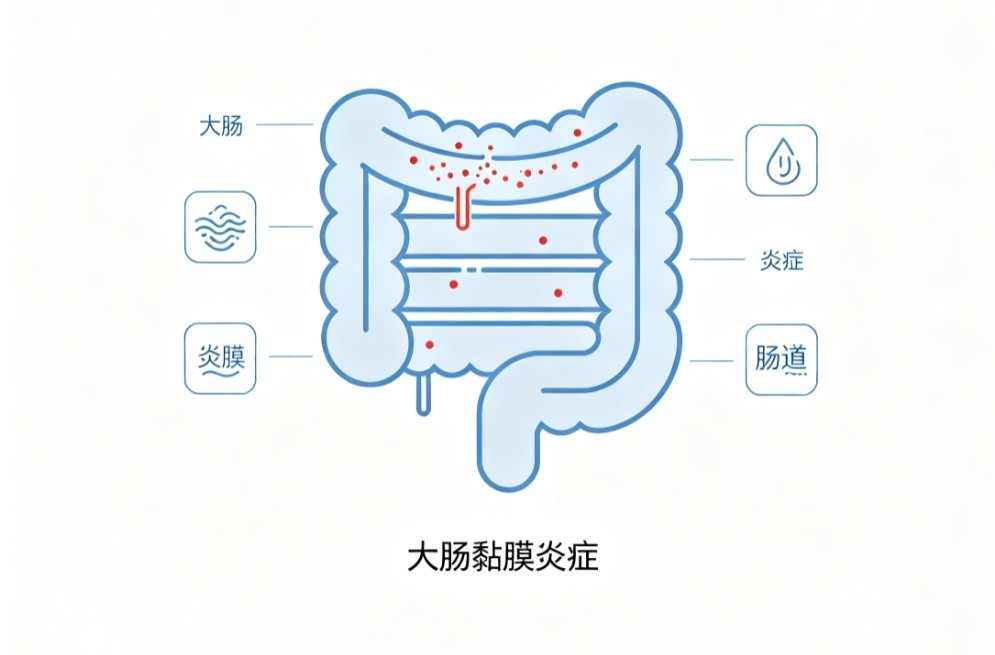 结肠炎