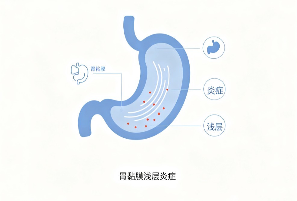 慢性浅表性胃炎