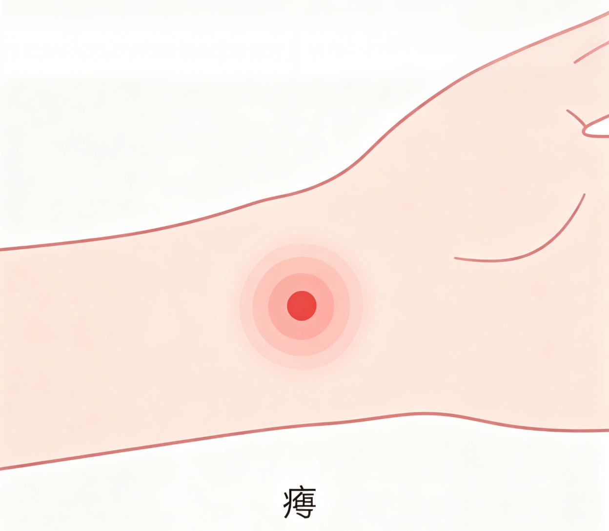 疔