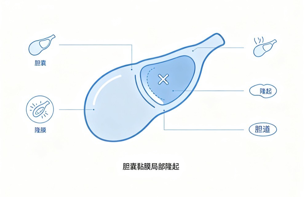 胆囊隆起性病变