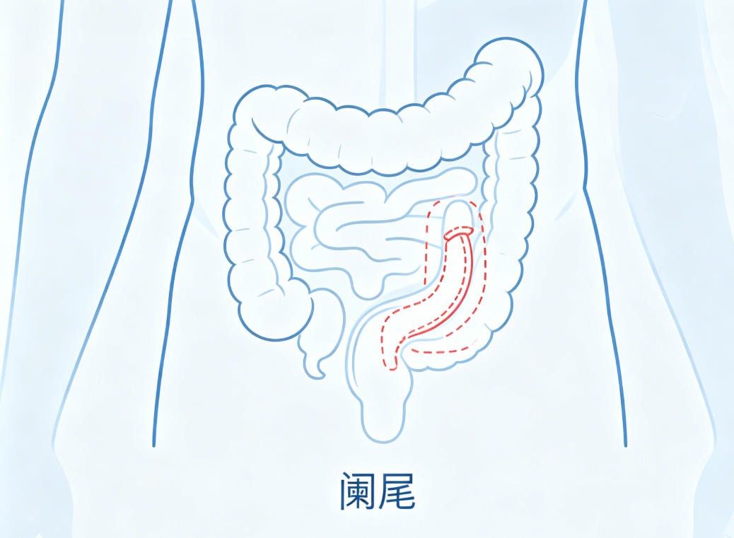 阑尾炎
