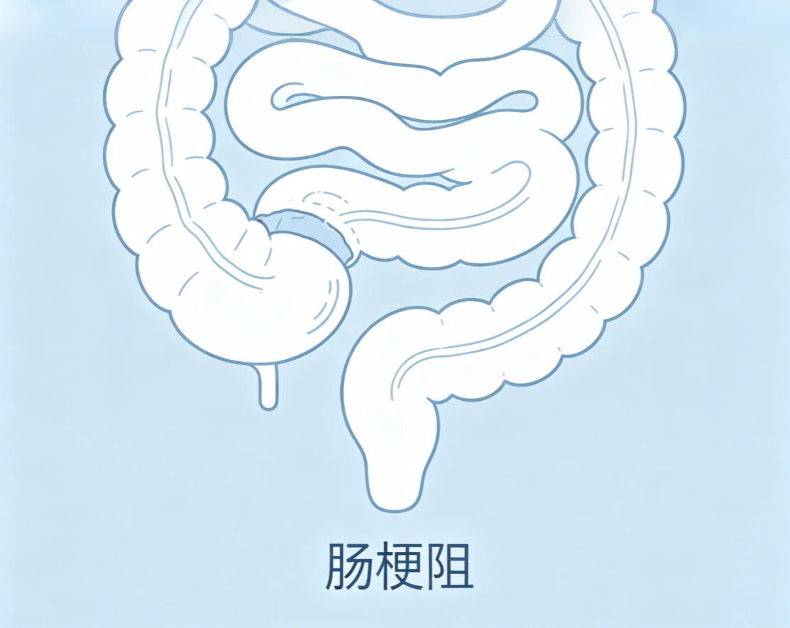 肠梗阻