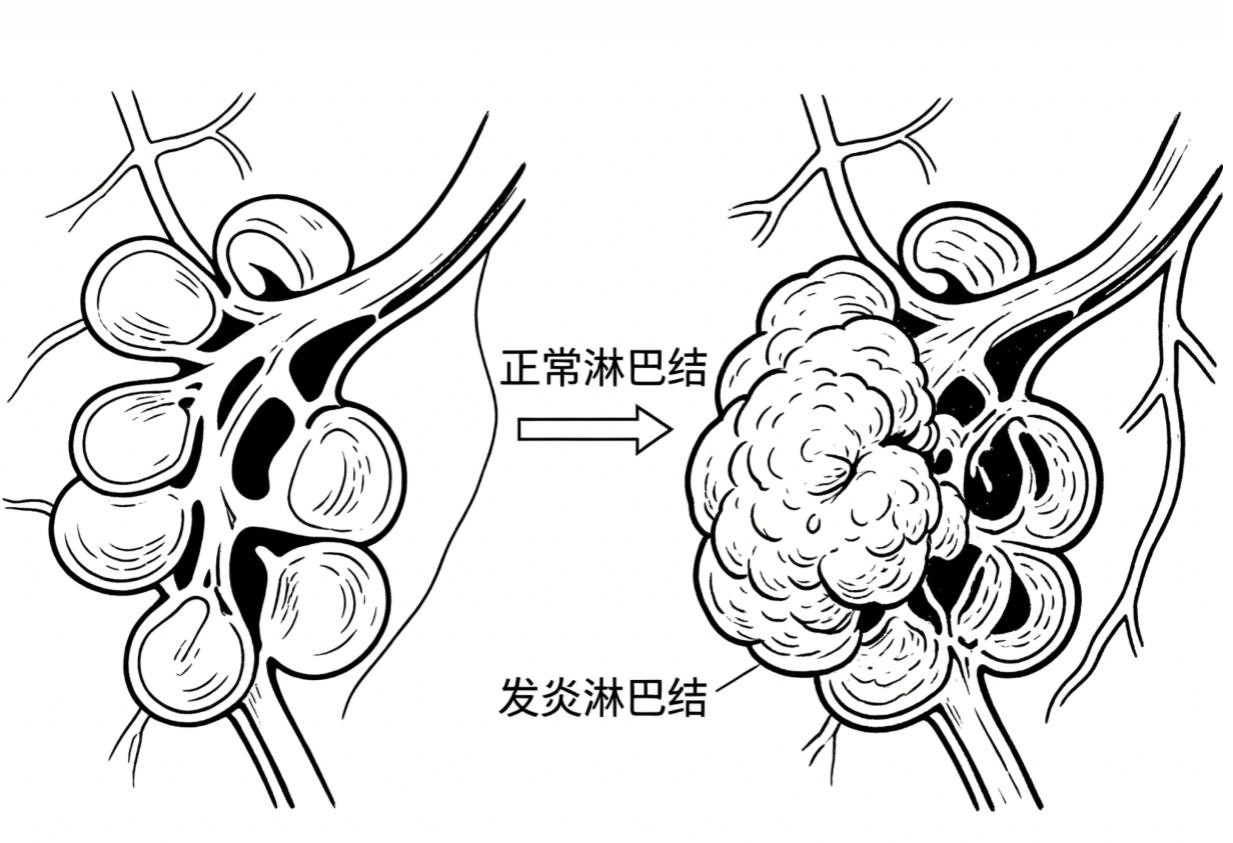 淋巴结炎