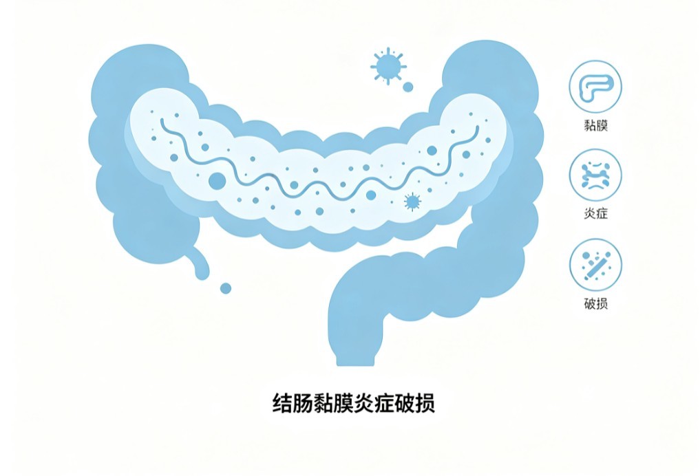 溃疡性结肠炎