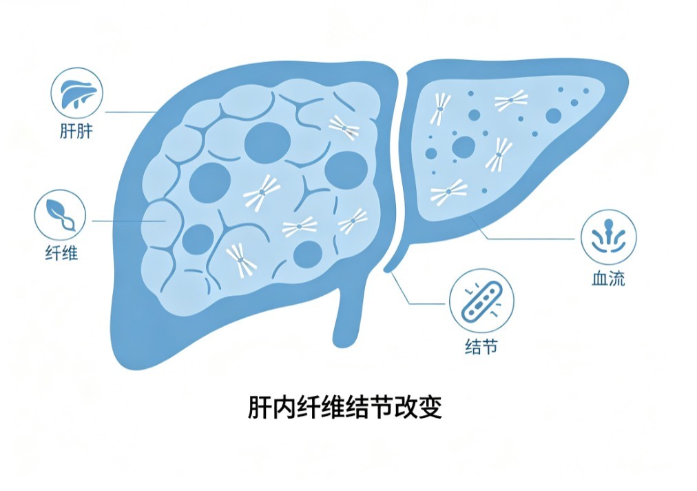 肝硬化