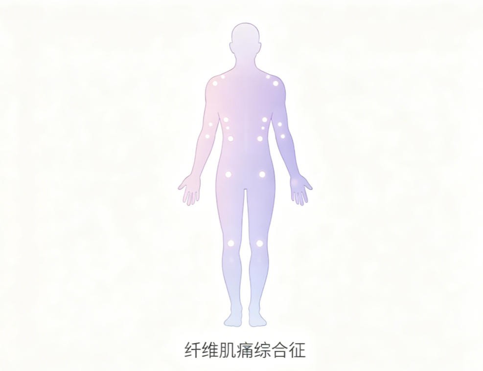 纤维肌痛综合征