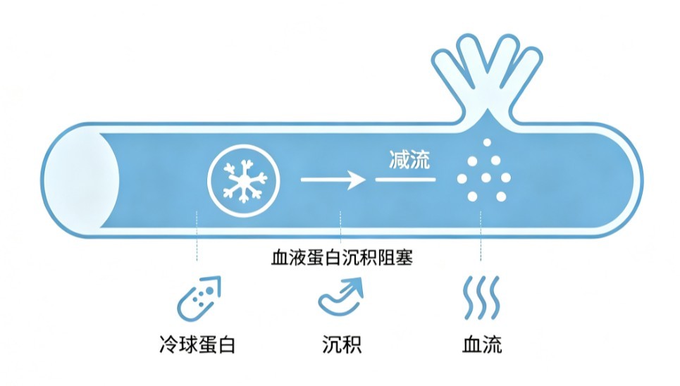 冷球蛋白血症