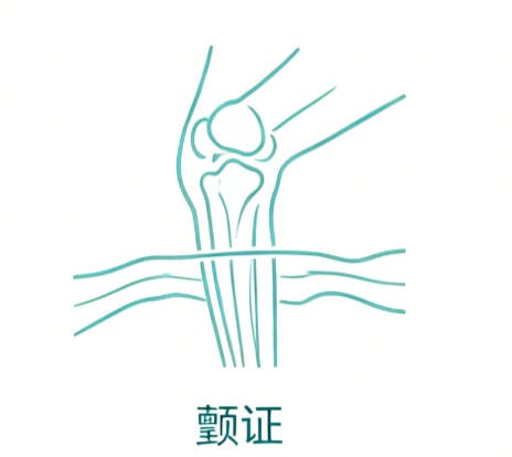 颤证