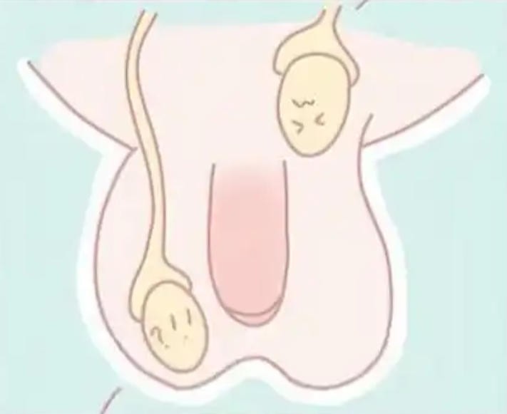 隐睾