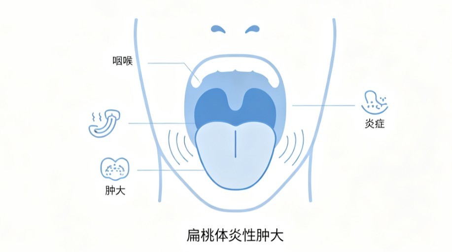 扁桃体肿大