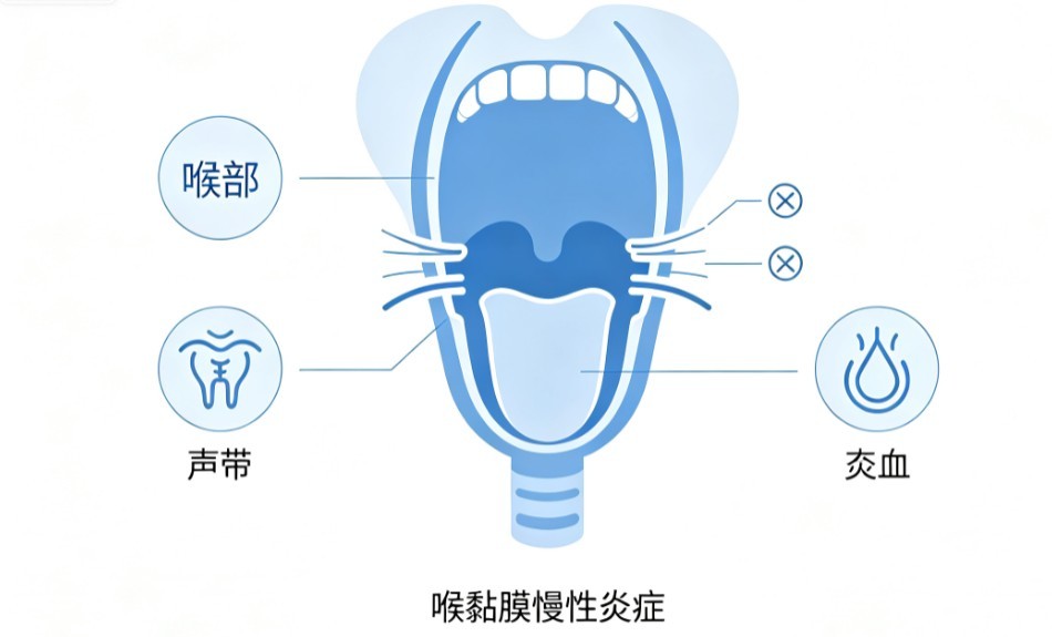慢性喉炎